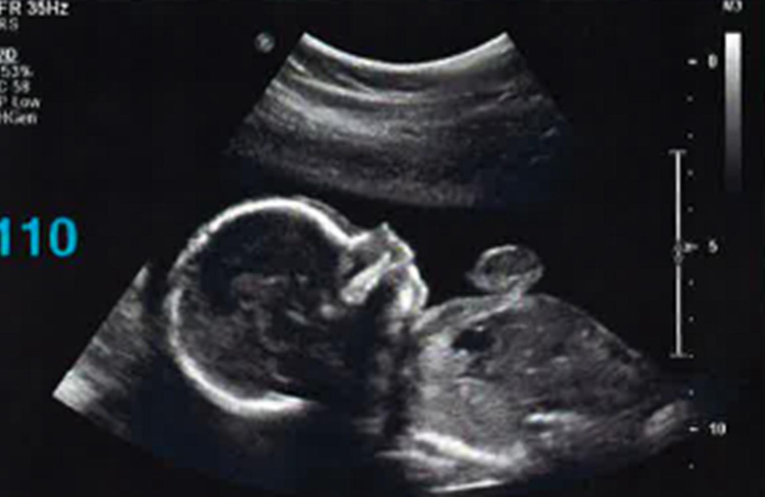 To tell pictures ultrasound boy or how girl Difference Between